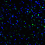 Immunofluorescence of TIGIT in human stomach carcinoma tissue using TIGIT Antibody at 5 μg/ml.<br><br>Green: TIGIT Antibody [7E5] (RF16051) <br> Blue: DAPI staining