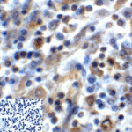 Immunohistochemistry of TIGIT in human stomach carcinoma tissue using TIGIT Antibody and control mouse IgG (corner box) at 2 μg/ml.