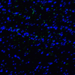 Immunofluorescence of TIM-3 in human colon carcinoma tissue with TIM-3 antibody at 20 μg/mL. <br><br>Green: TIM-3 Antibody [10C10] (RF16103) <br> Blue: DAPI staining