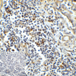 Immunohistochemistry of TIM-3 in human colon carcinoma tissue with TIM-3 antibody at 5 μg/mL.