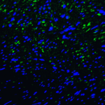 Immunofluorescence of TIM-3 in human colon carcinoma tissue with TIM-3 antibody at 20 μg/mL. <br><br>Green: TIM-3 Antibody [1B10] (RF16107) <br> Blue: DAPI staining