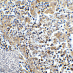 Immunohistochemistry of TIM-3 in human colon carcinoma tissue with TIM-3 antibody at 5 μg/mL.