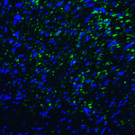 Immunofluorescence of TIM-3 in human colon carcinoma tissue with TIM-3 antibody at 20 μg/mL. <br><br>Green: TIM-3 Antibody [1C6] (RF16108) <br> Blue: DAPI staining