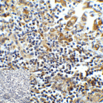 Immunohistochemistry of TIM-3 in human colon carcinoma tissue with TIM-3 antibody at 5 μg/mL.