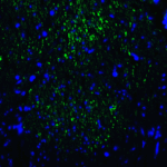 Immunofluorescence of TIM-3 in human colon carcinoma tissue with TIM-3 antibody at 20 μg/mL. <br><br>Green: TIM-3 Antibody [2A6] (RF16106) <br> Blue: DAPI staining
