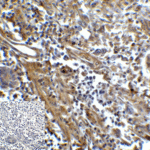 Immunohistochemistry of TIM-3 in human colon carcinoma tissue with TIM-3 antibody at 5 μg/mL.