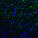 Immunofluorescence of TIM-3 in human colon carcinoma tissue with TIM-3 antibody at 20 μg/mL. <br><br>Green: TIM-3 Antibody [3G7] (RF16105) <br> Blue: DAPI staining