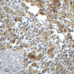 Immunohistochemistry of TIM-3 in human colon carcinoma tissue with TIM-3 antibody at 5 μg/mL.