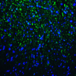 Immunofluorescence of TIM-3 in human colon carcinoma tissue with TIM-3 antibody at 20 μg/mL. <br><br>Green: TIM-3 Antibody [9G1] (RF16109) <br> Blue: DAPI staining