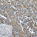 Immunohistochemistry of TIM-3 in human colon carcinoma tissue with TIM-3 antibody at 5 μg/mL.