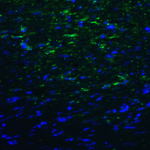 Immunofluorescence of TMIGD2 in human colon carcinoma tissue with TMIGD2 antibody at 20 μg/mL.
