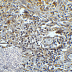 Immunohistochemistry of TMIGD2 in human colon carcinoma tissue with TMIGD2 antibody at 5 μg/mL.