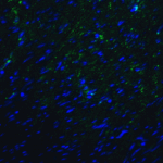 Immunofluorescence of TMIGD2 in human colon carcinoma tissue with TMIGD2 antibody at 20 μg/mL.