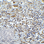 Immunohistochemistry of TMIGD2 in human colon carcinoma tissue with TMIGD2 antibody at 5 μg/mL.