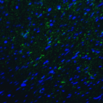 Immunofluorescence of TMIGD2 in human colon carcinoma tissue with TMIGD2 antibody at 20 μg/mL.