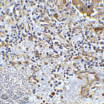 Immunohistochemistry of TMIGD2 in human colon carcinoma tissue with TMIGD2 antibody at 5 μg/mL.