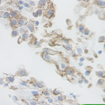 This antibody stained formalin-fixed, paraffin-embedded sections of human renal cell carcinoma.  The recommended concentration is 2.5 ug/ml- 1.5 ug/ml with an overnight incubation at 4C.  An HRP-labeled polymer detection system was used with a DAB chromogen.  Heat induced antigen retrieval with a pH 9.0 buffer is recommended.  Optimal concentrations and conditions may vary.