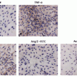 <strong>Figure 5 Induction Validation of TSLP in Rat VSMCs (Zhao et al., 2012)</strong><br> Immunohistochemical images showing the TSLP protein detected by anti-TSLP antibodies in Rat VSMCs without (Control) or with treatment with TNF-alpha, Ang II, Ang II+PDTC , Ang II +valsartan.  TNF-α treatment is used as a positive control. The production of TSLP was increased after Ang II treatment.