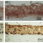 <strong>Figure 9 Induced Expression Validation of TSLP in Human Corneal Tissues (Lin et al., 2013) </strong><br>Immunohistochemical images showing TSLP protein detected by anti-TSLP antibodies in ex vivo donor human corneal tissues without (B1) or with exposure to IL-33 (10ng/mL) (B2). An isotype IgG antibody (B3) was used as a negative control. Magnificaiton 400X. The staining confirms the increased level of TSLP after IL-33 treatment.