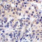 Immunohistochemistry of VISTA in human lymphoma tissue with VISTA antibody at 2 μg/mL.