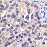 Immunohistochemistry of VISTA in human lymphoma tissue with VISTA antibody at 2 μg/mL.