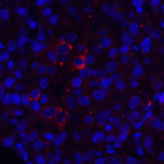 Immunofluorescence of VISTA in human lymphoma tissue with VISTA antibody at 10 μg/mL. <br><br>Red: VISTA Antibody [9E4] (RF16074) <br> Blue: DAPI staining