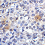 Immunohistochemistry of VISTA in human lymphoma tissue with VISTA antibody at 2 μg/mL.