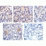 Immunohistochemistry of VISTA in human lymphoma tissue using (A) RF16071, (B) RF16072, (C) RF16073, (D) RF16074, and (E) control mouse IgG antibody at 2 μg/ml.