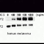 Western blot of human melanoma cells incubated with varying doses of the radiometric drug NCS showing phospho-specific immunolabeling of the ATF2 protein phosphorylated at Ser 490,498.
