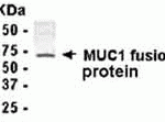 Anti-MUC-1 IgY staining of Formalin-fixed and paraffin-embedded Esophogeal Cancer tissue. Affinity-purified IgY dilution: 1:100, Rabbit anti-IgY-Biotin dilution: 1:300. (Courtesy of Jessica Wang-Rodriguez MD, UCSD & VA San Diego Healthcare System.)<br><br>E coli-derived fusion protein as test antigen. Affinity-purified IgY dilution: 1:2000, Goat anti-IgY-HRP dilution: 1:1000. Colorimetric method for signal development.