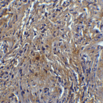 <strong>Figure 8 Immunohistochemistry Validation of hRIP3 in Human Breast Tissue</strong><br> Immunohistochemical analysis of paraffin-embedded human breast tissue using anti-hRIP3 antibody (8963) at 5 μg/ml. Tissue was fixed with formaldehyde and blocked with 10% serum for 1 h at RT; antigen retrieval was by heat mediation with a citrate buffer (pH6). Samples were incubated with primary antibody overnight at 4°C. A goat anti-rabbit IgG H&L (HRP) at 1/250 was used as secondary. Counter stained with Hematoxylin.