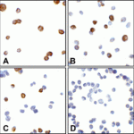 Immunocytochemistry of CTLA-4 in overexpressing 293 cells using (A) RF16011, (B) RF16012, (C) RF16013, and (D) control mouse IgG antibody at 5 μg/ml.