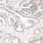 This antibody stained formalin-fixed, paraffin-embedded sections of human prostate malignant adenocarcinoma. The recommended concentration is 0.75ug/ml with an overnight incubation at 4°C. An HRP-labeled polymer detection system was used with a DAB chromogen. Heat induced antigen retrieval with a pH 6.0 sodium citrate buffer is recommended. Optimal concentrations and conditions may vary.