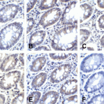 Immunohistochemistry of PD-L2 in human colon carcinoma tissue using (A) RF16021, (B) RF16022, (C) RF16023, (D) RF16024, (E) RF16025, and (F) control mouse IgG antibody at 2 μg/ml.