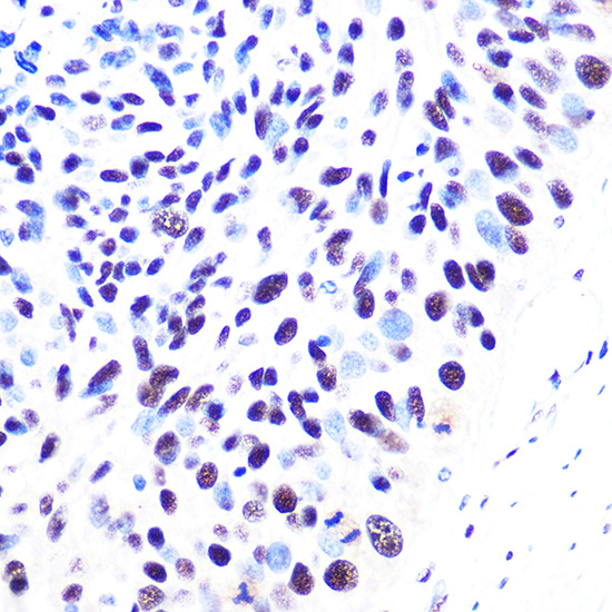 Immunohistochemistry analysis of paraffin-embedded Human esophageal cancer using 53BP1 Rabbit mAb (A3859) at dilution of 1:100 (40x lens). Microwave antigen retrieval performed with 0.01M PBS Buffer (pH 7.2) prior to IHC staining.