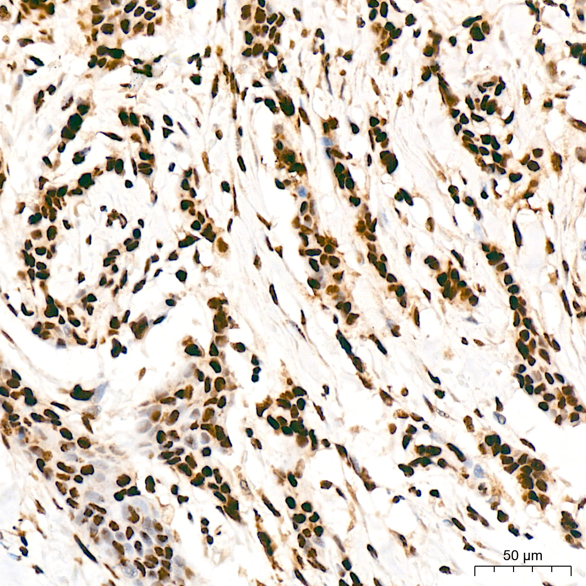 Immunohistochemistry analysis of paraffin-embedded Human breast cancer tissue using FUBP1 Rabbit mAb at a dilution of 1:200 (40x lens). High pressure antigen retrieval was performed with 0.01 M citrate buffer (pH 6.0) prior to IHC staining.