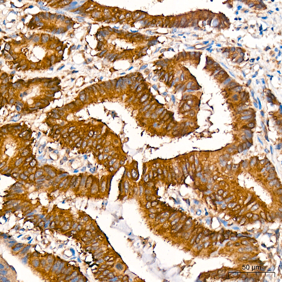 Immunohistochemistry analysis of paraffin-embedded Human colon carcinoma tissue using RALBP1 Rabbit mAb at a dilution of 1:200 (40x lens). High pressure antigen retrieval was performed with 0.01 M citrate buffer (pH 6.0) prior to IHC staining.