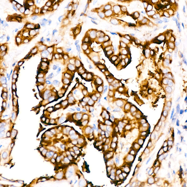 Immunohistochemistry analysis of paraffin-embedded Human thyroid cancer using Thyroglobulin Rabbit mAb (A3407) at dilution of 1:100 (40x lens). High pressure antigen retrieval performed with 0.01M Citrate buffer (pH 6.0) prior to IHC staining.