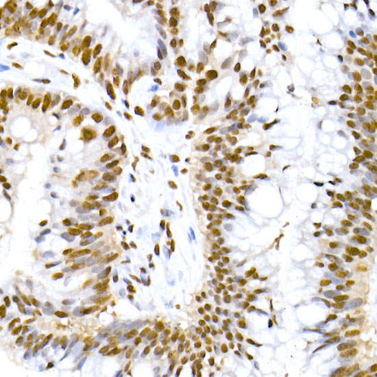 Immunohistochemistry analysis of paraffin-embedded Human colon carcinoma using Phospho-MDM2-S166 Rabbit mAb at dilution of 1:20 (40x lens). High pressure antigen retrieval performed with 0.01M Citrate buffer (pH 6.0) prior to IHC staining.