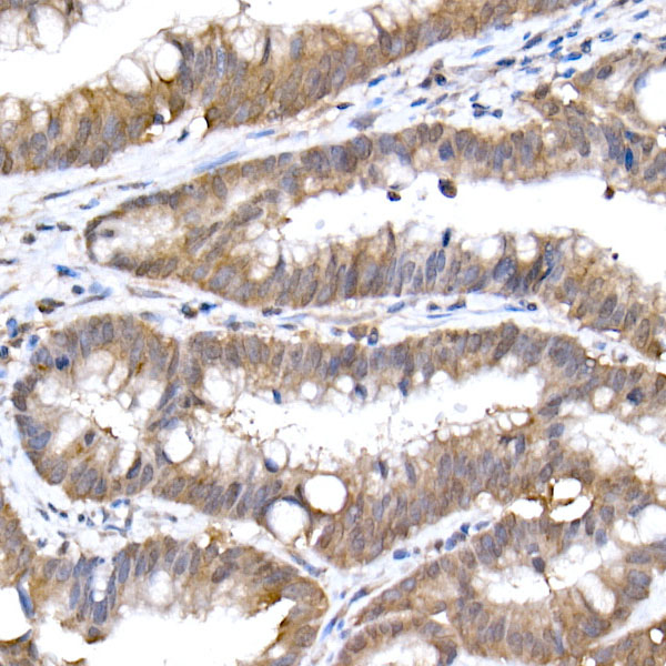 Immunohistochemistry analysis of paraffin-embedded Human colon carcinoma using SFT Rabbit mAb at dilution of 1:50 (40x lens). High pressure antigen retrieval performed with 0.01M Citrate buffer (pH 6.0) prior to IHC staining.