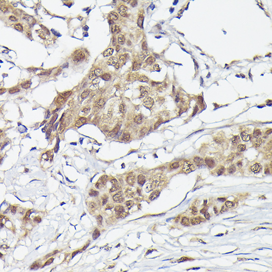 Immunohistochemistry analysis of paraffin-embedded Human breast cancer using PFKFB3 Rabbit mAb at dilution of 1:100 (40x lens). High pressure antigen retrieval performed with 0.01M Citrate buffer (pH 6.0) prior to IHC staining.