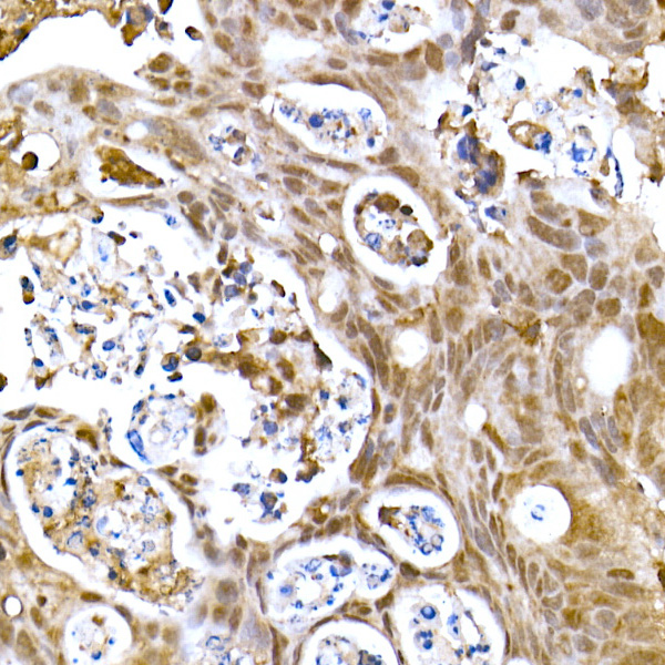 Immunohistochemistry analysis of paraffin-embedded Human colon carcinoma using SOCS1 Rabbit mAb at dilution of 1:100 (40x lens). High pressure antigen retrieval performed with 0.01M Citrate buffer (pH 6.0) prior to IHC staining.