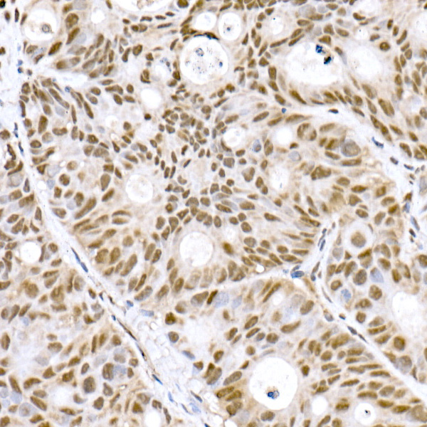 Immunohistochemistry analysis of paraffin-embedded Human colon carcinoma using Prdm9 Rabbit mAb at dilution of 1:800 (40x lens). High pressure antigen retrieval performed with 0.01M Citrate buffer (pH 6.0) prior to IHC staining.