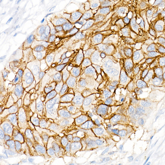 Immunohistochemistry analysis of paraffin-embedded Human lung squamous carcinoma tissue using CD141/Thrombomodulin Rabbit mAb at dilution of 1:1000 (40x lens). High pressure antigen retrieval performed with 0.01M Citrate buffer (pH 6.0) prior to IHC staining.