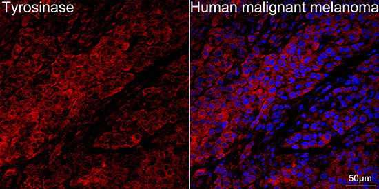 Confocal imaging of paraffin-embedded Human malignant melanoma tissue using Tyrosinase Rabbit mAb (A21267, dilution 1:200) followed by a further incubation with Cy3 Goat Anti-Rabbit IgG (H+L) (AS007, dilution 1:500) (Red). DAPI was used for nuclear staining (Blue). Objective: 40x. Perform high pressure antigen retrieval with 0.01 M citrate buffer (pH 6.0) prior to IF staining.