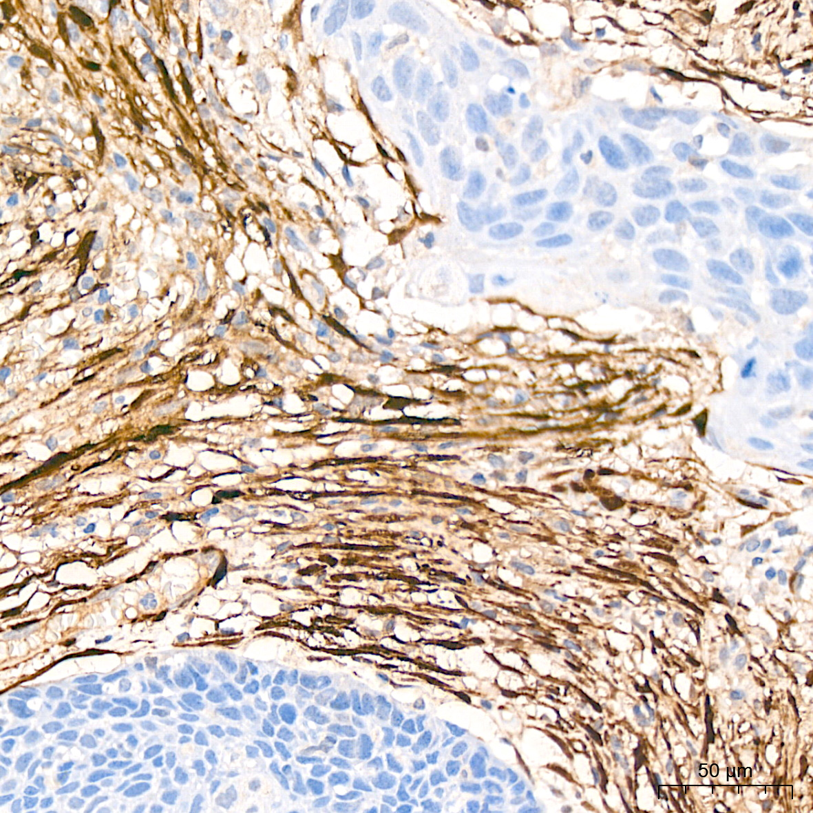 Immunohistochemistry analysis of paraffin-embedded Human cervix cancer tissue using Transgelin (TAGLN) Rabbit mAb (A21209) at a dilution of 1:1000 (40x lens). High pressure antigen retrieval was performed with 0.01 M citrate buffer (pH 6.0) prior to IHC staining.