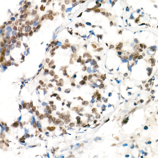 Immunohistochemistry analysis of paraffin-embedded Human lung cancer using Phospho-STAT3-Y705 Rabbit mAb at dilution of 1:100 (40x lens). High pressure antigen retrieval performed with 0.01M Citrate buffer (pH 6.0) prior to IHC staining.