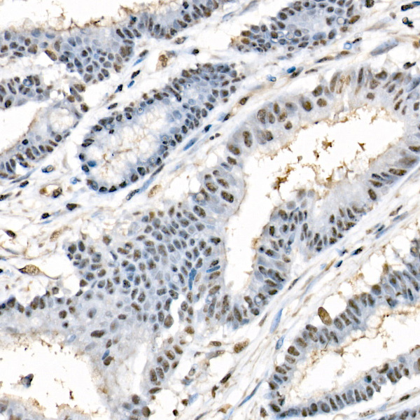 Immunohistochemistry analysis of paraffin-embedded Human colon carcinoma tissue using Phospho-Beclin 1-S90 Rabbit mAb at a dilution of 1:100 (40x lens). High pressure antigen retrieval performed with 0.01M Citrate Buffer (pH 6.0) prior to IHC staining.