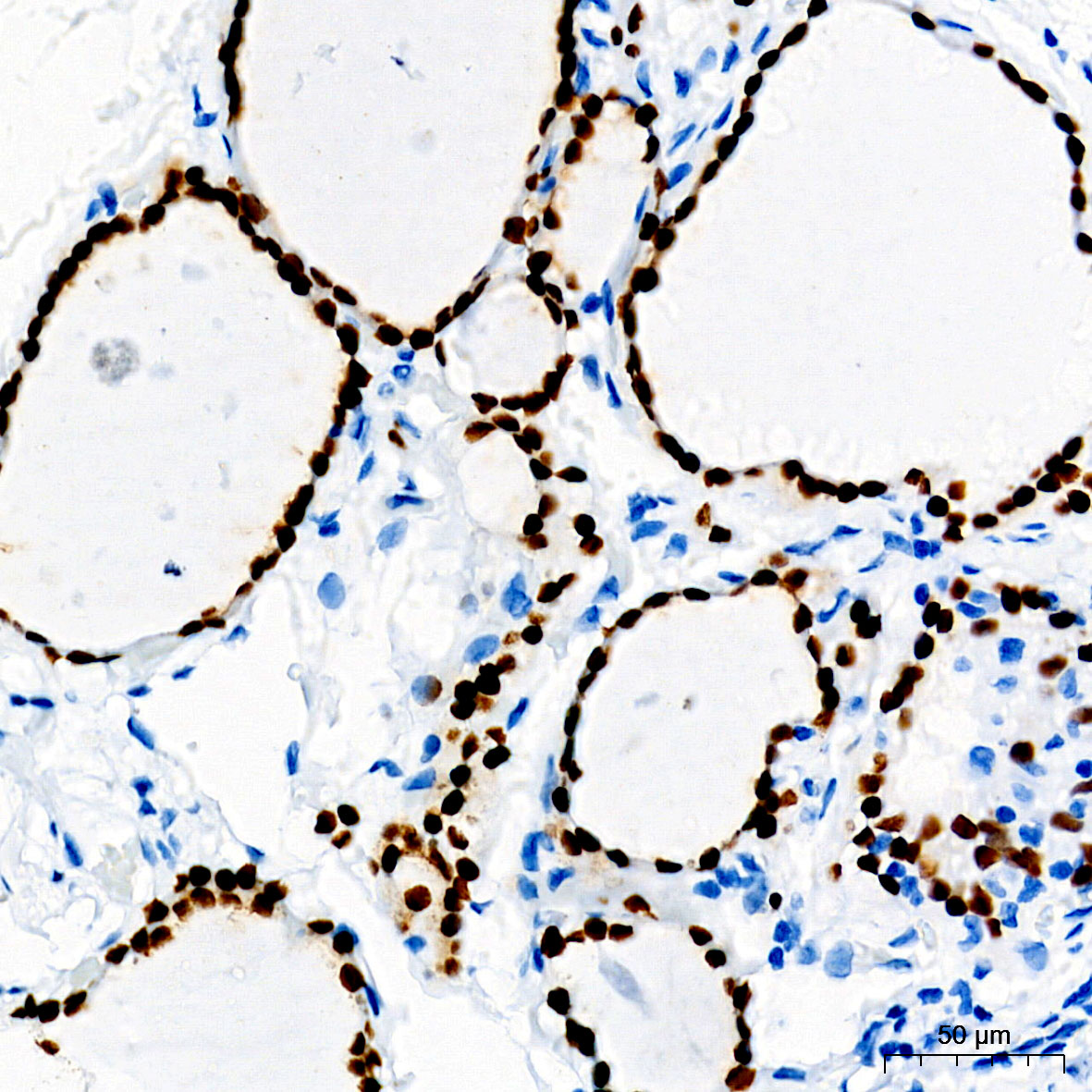 Immunohistochemistry analysis of paraffin-embedded Human thyroid tissue using PAX8 Rabbit mAb at a dilution of 1:1500 (40x lens). High pressure antigen retrieval performed with 0.01M Tris-EDTA Buffer (pH 9.0) prior to IHC staining.