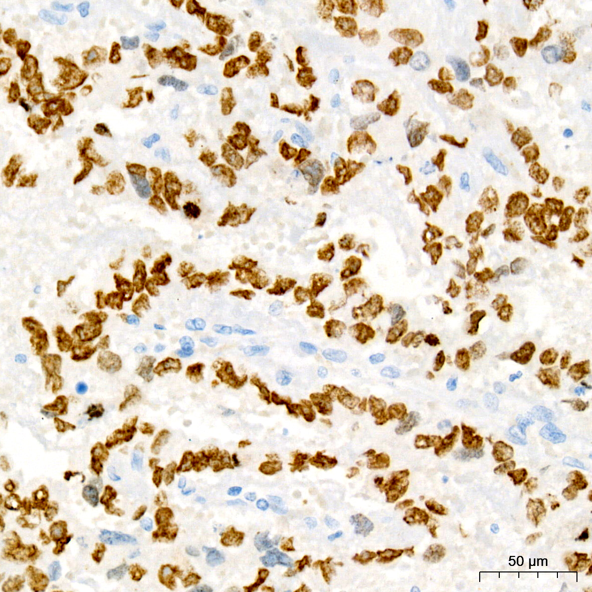 Immunohistochemistry analysis of paraffin-embedded Human embryonic carcinoma using Sall4 Rabbit mAb at dilution of 1:200 (40x lens). High pressure antigen retrieval performed with 0.01M Tris/EDTA Buffer (pH 9.0) prior to IHC staining.